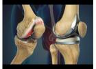 Experienced Knee Replacement Surgeon in Vaishali Nagar – Dr. Arvind Asopa